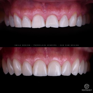 Image of Porcelain veneers