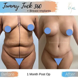 Image of Tummy tuck