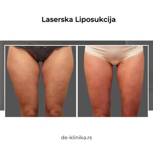 Image of Liposuction