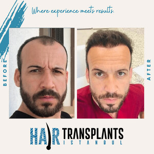 Image of Hair Transplant Istanbul (HTI) Gallery 0