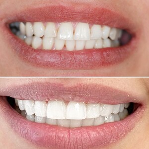 Image of Veneers - DentalARIA