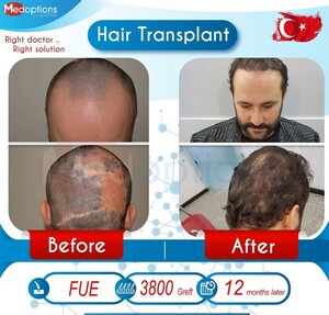 Image of Hair transplant before and after