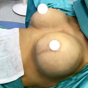 Image of Breast augmentation