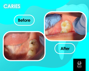 Image of Fillings