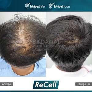 Image of BEQ Clinic - Dr. Danai Bangkok Hair Transplant Gallery 1