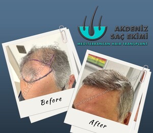 Image of Hair transplant before and after