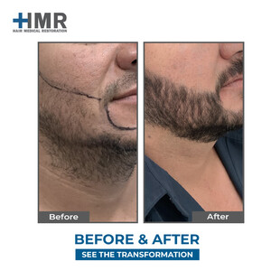 Image of Beard transplant