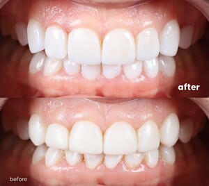 Image of Teeth whitening