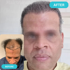 Image of Hairtransplantation.com Gallery 3