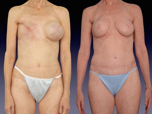 Image of Center for Restorative Breast Surgery Gallery 3