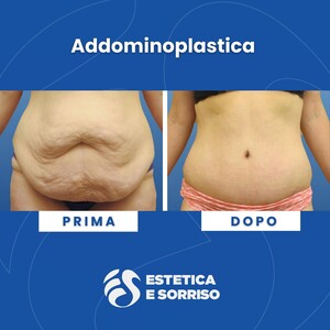 Image of Tummy Tuck - Estetica e Sorriso