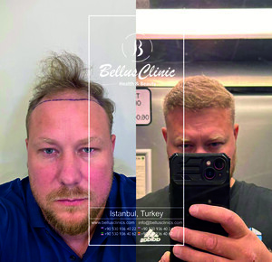 Image of Hair Transplant result of our patient from Poland