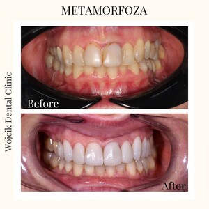 Image of Dental crowns