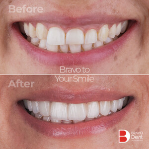 Image of Teeth whitening before and after