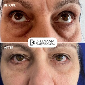 Image of Eyelid surgery, Dr. Diana Gheorghita