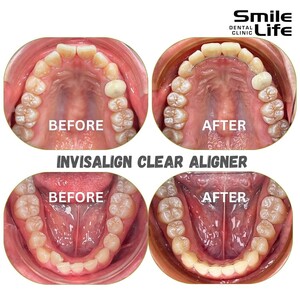 Image of Invisalign