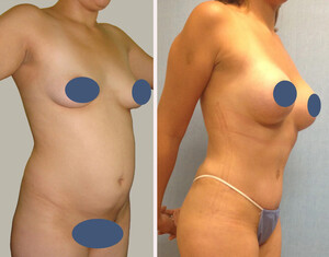 Image of Body contouring