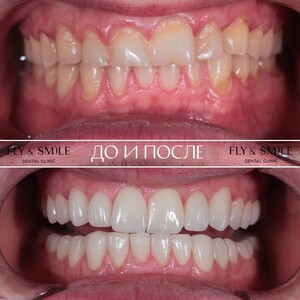 Image of Smile makeover before and after