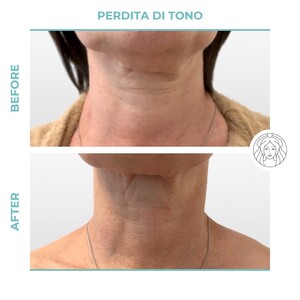 Image of Neck lift - Dr Juri Tassinari