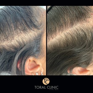 Image of Hair loss treatment before and after