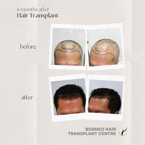 Image of Borneo Hair Transplant Centre Gallery 3