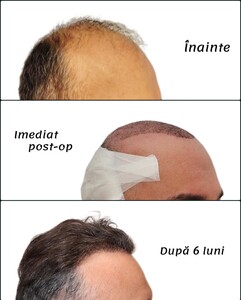 Image of Dr Felix Hair Implant Gallery 1