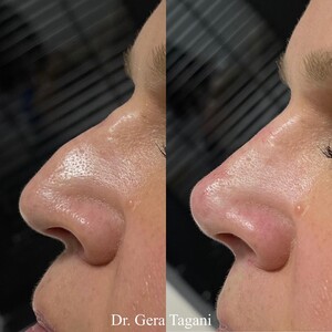 Image of Rhinoplasty - Dr Gera Tagani