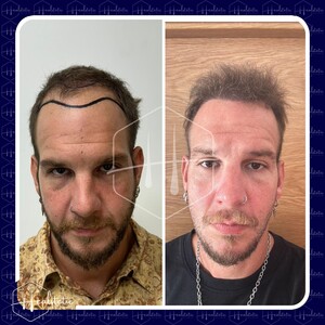 Image of Hair transplant - Healstetic Clinic