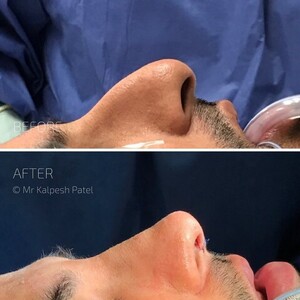 Image of London Rhinoplasty Gallery 0