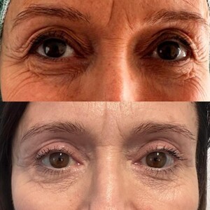 Image of Eyelid surgery