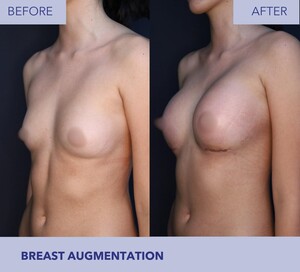 Image of Breast Augmentation