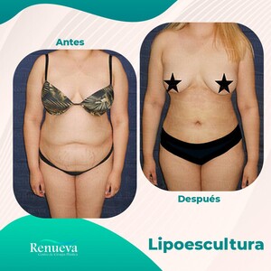 Image of Liposuction before and after