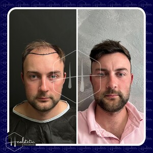 Image of Hair transplant procedure - Healstetic Clinic