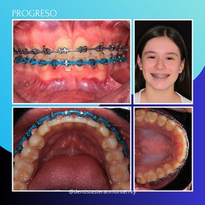 Image of Braces