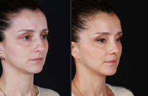 Image of Rhinoplasty after 2 months