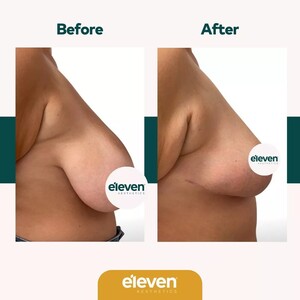 Image of Breast Reduction - Eleven Aesthetics