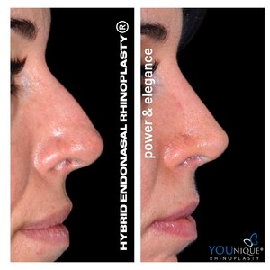 Image of Endonasal rhinoplasty before and after