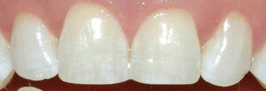 Image of Composite fillings