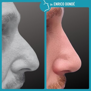 Image of Rhinoplasty procedure