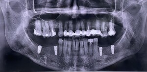 Image of Dental Implants