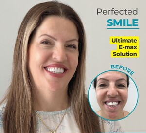 Image of Emax veneers