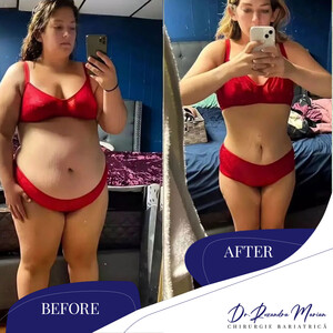 Image of Bariatric surgery before and after - Dr. Ruxandra Marian