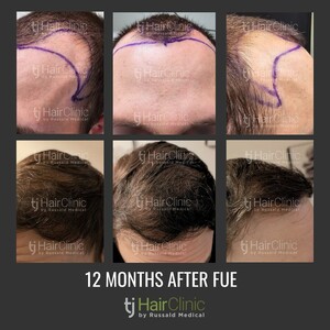 Image of 12 months after FUE