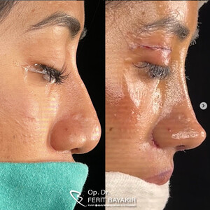 Image of Bursa Rhinoplasty - Op. Dr. Ferit Bayakır Gallery 1