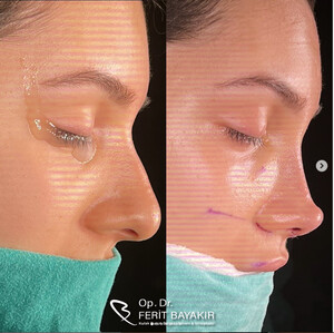 Image of Bursa Rhinoplasty - Op. Dr. Ferit Bayakır Gallery 0