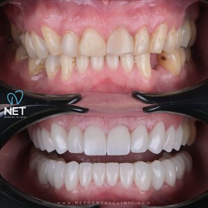 Image of Smile makeover