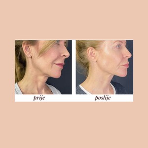 Image of Jawline procedure - Thalassotherapia Hospital