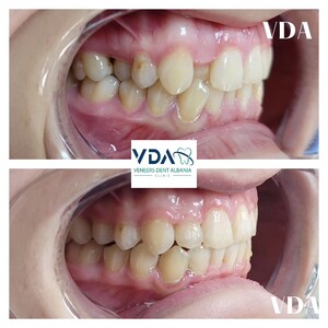 Image of Veneers Dent Albania Clinic Gallery 1