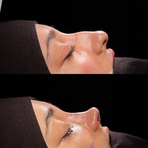 Image of Umman Tunç - Rhinoplasty Clinic Gallery 3