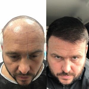 Image of Hair transplant - Legend Hair Transplant